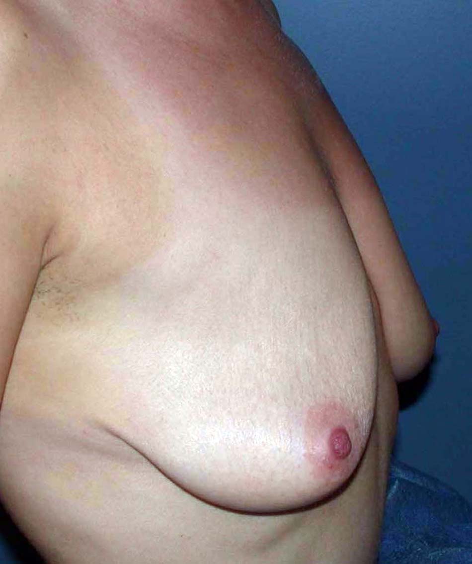 chirurgie-esthetique-ptose-sans-implant06