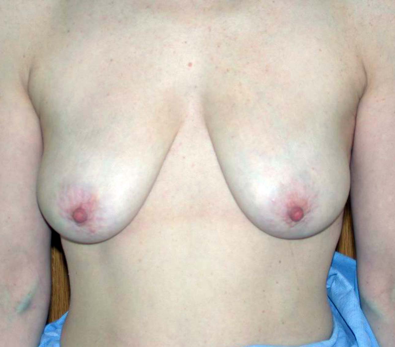 chirurgie-esthetique-ptose-sans-implant08