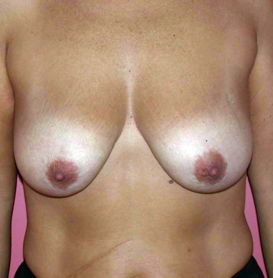 chirurgie-esthetique-ptose-sans-implant14