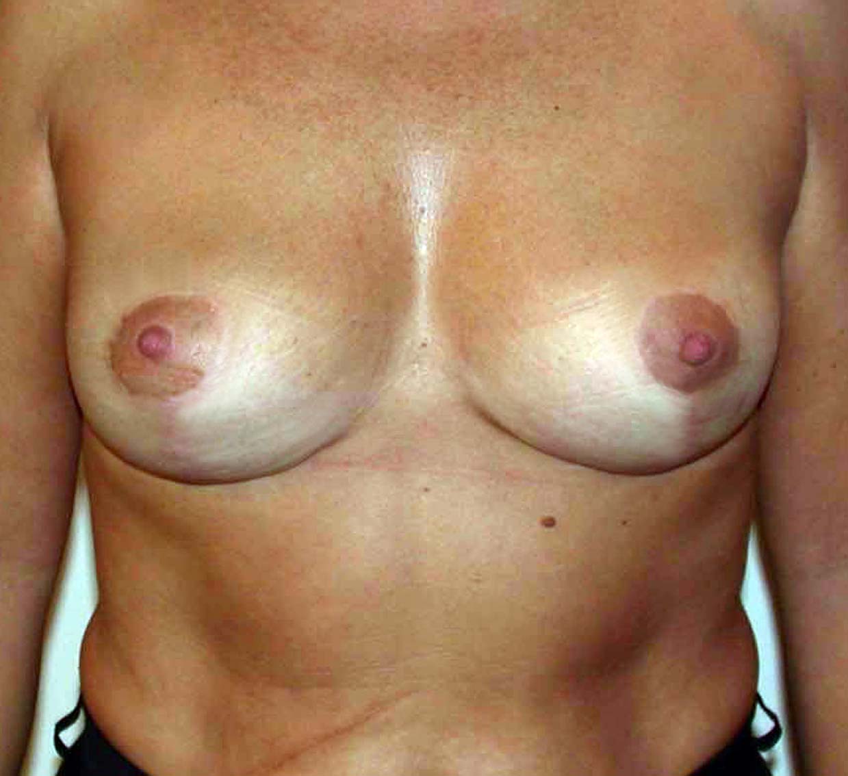 chirurgie-esthetique-ptose-sans-implant15