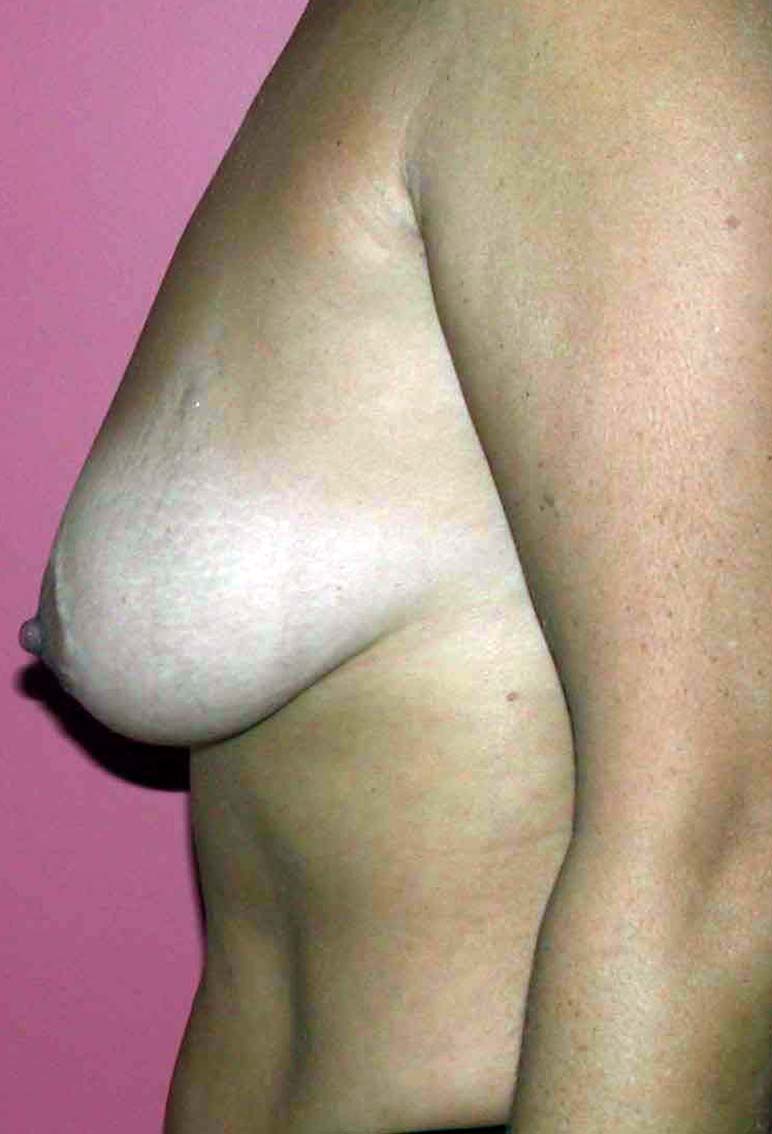 chirurgie-esthetique-ptose-sans-implant16