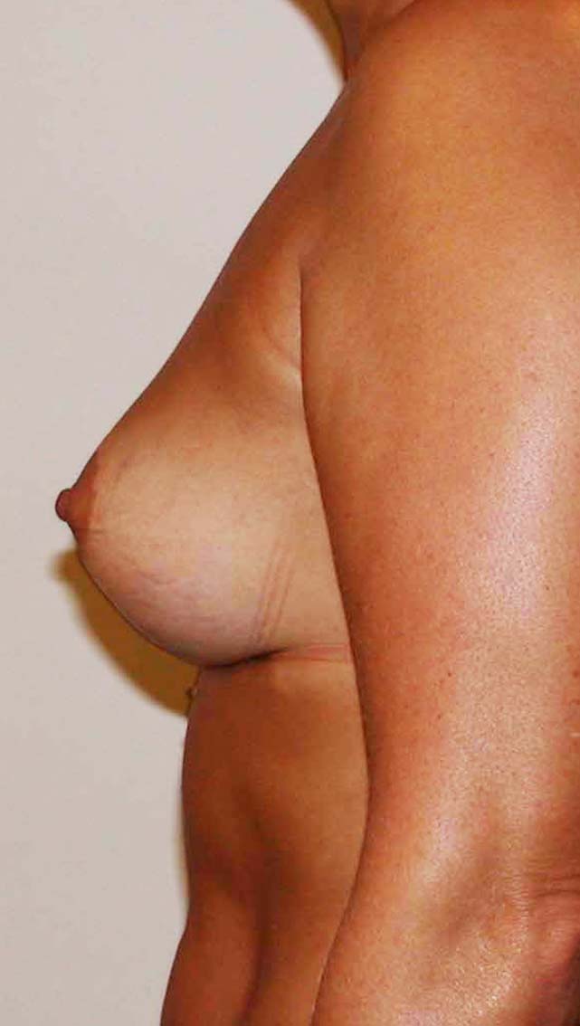 chirurgie-esthetique-ptose-sans-implant17