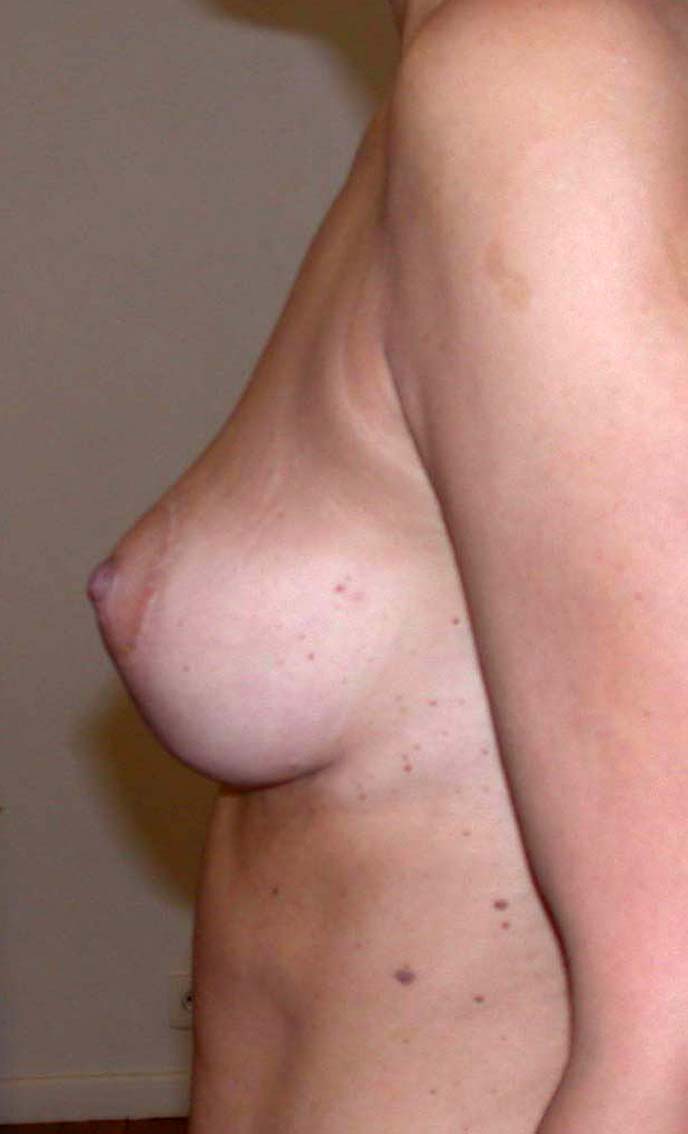 chirurgie-esthetique-ptose-sans-implant23