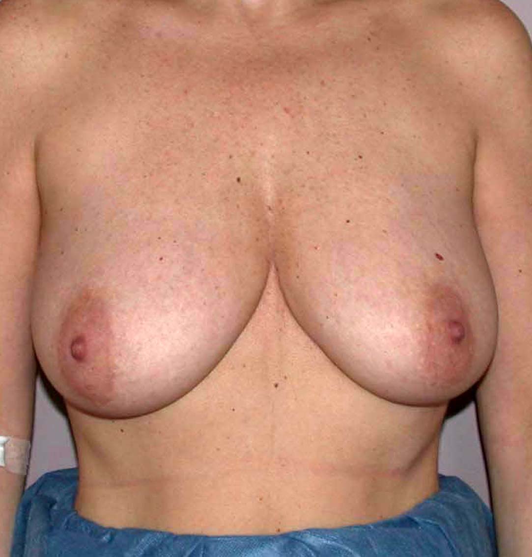 chirurgie-esthetique-ptose-sans-implant24