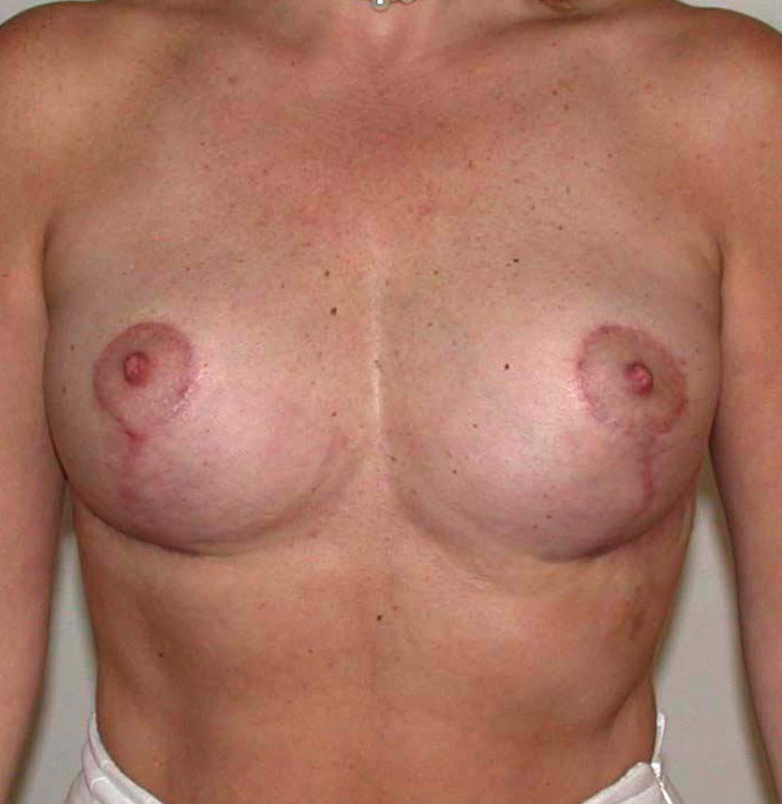 chirurgie-esthetique-ptose-sans-implant25