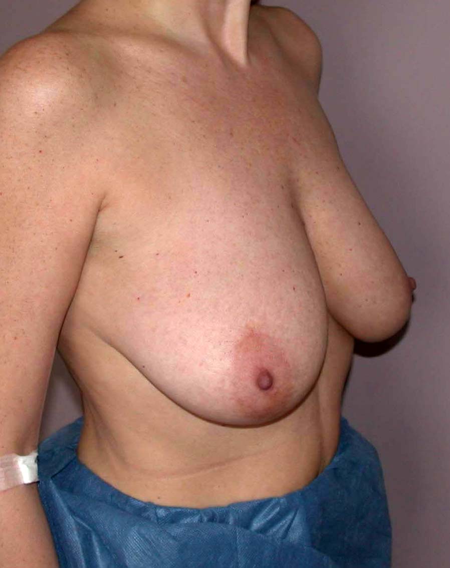 chirurgie-esthetique-ptose-sans-implant26