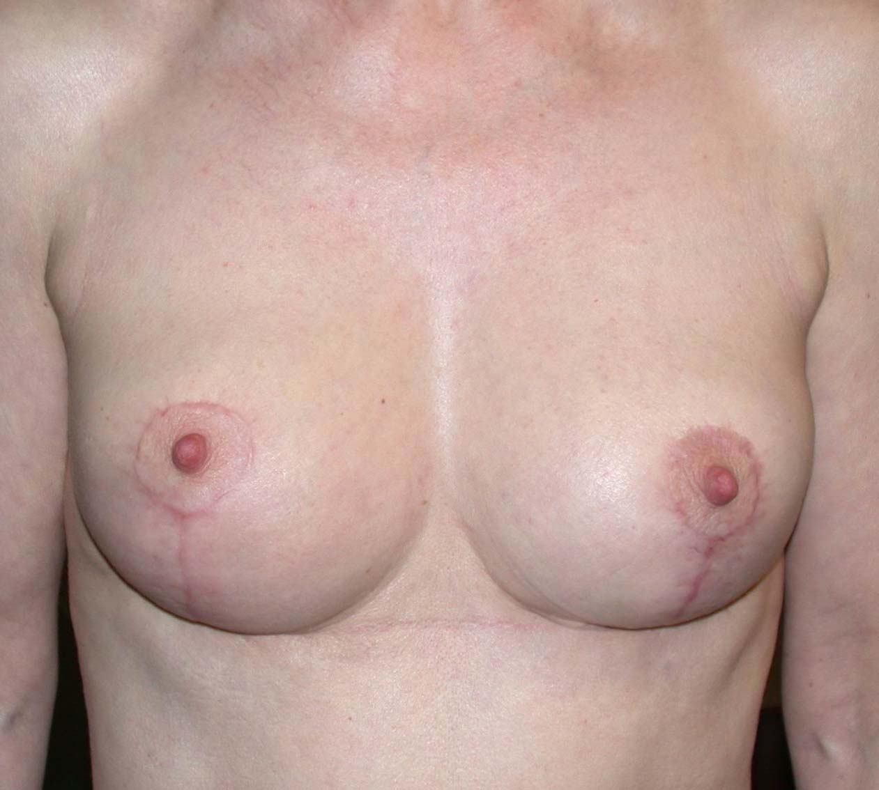 chirurgie-esthetique-ptose-sans-implant29