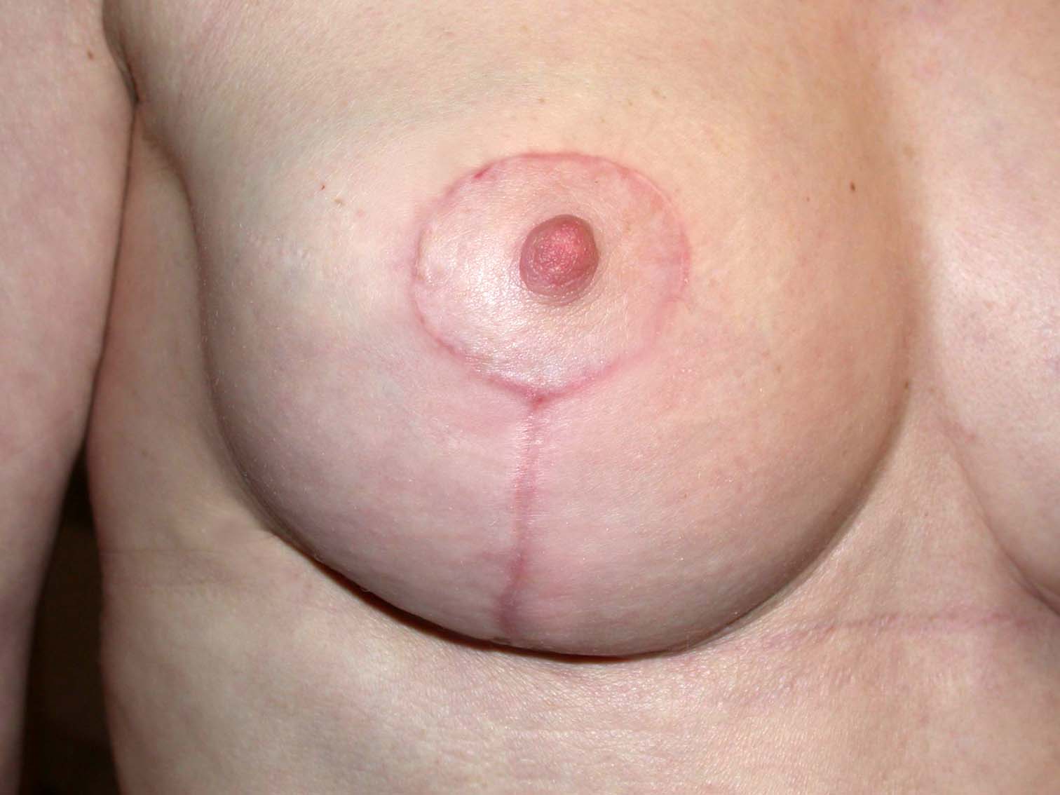 chirurgie-esthetique-ptose-sans-implant30