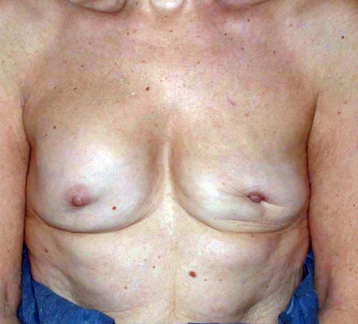 chirurgie-esthetique-secondaire-pnahon002