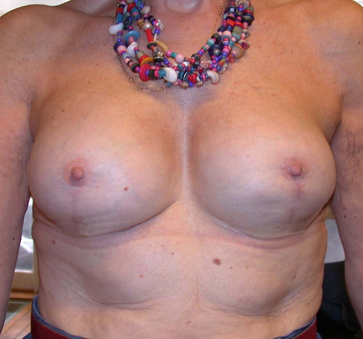 chirurgie-esthetique-secondaire-pnahon003