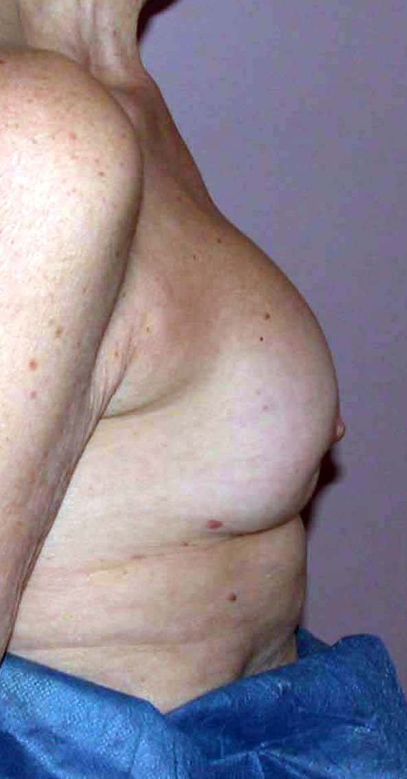 chirurgie-esthetique-secondaire-pnahon004