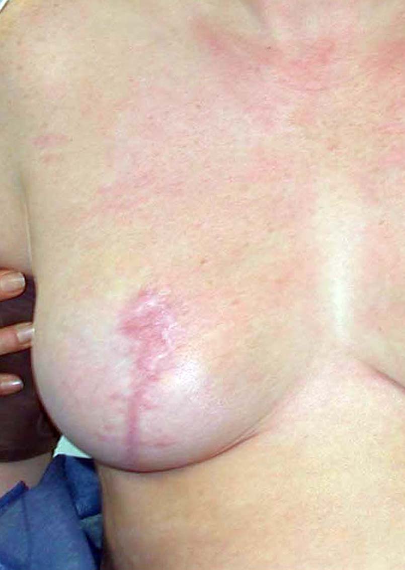 chirurgie-esthetique-secondaire-pnahon008