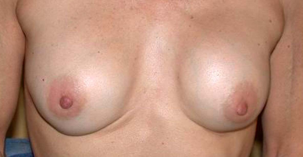 chirurgie-esthetique-secondaire-pnahon010