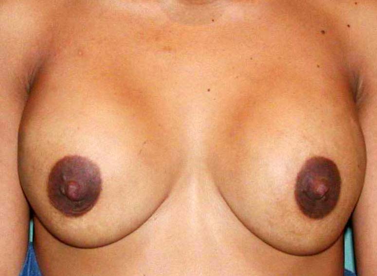 chirurgie-esthetique-secondaire-pnahon014