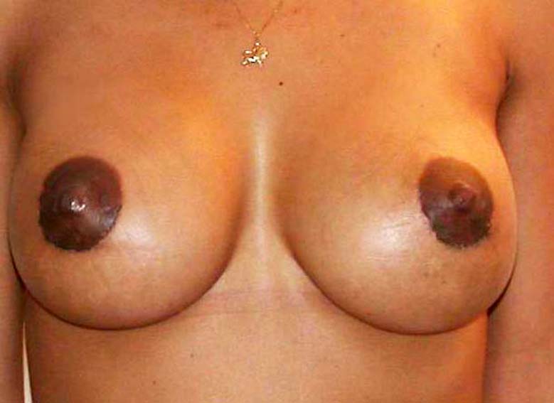 chirurgie-esthetique-secondaire-pnahon015