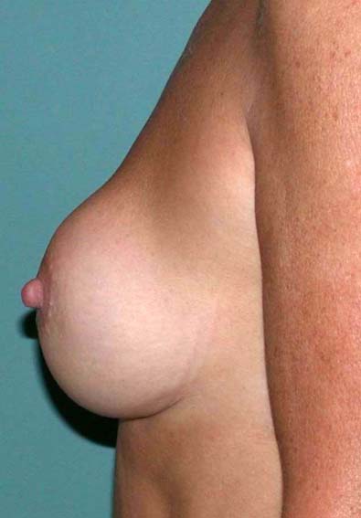 chirurgie-esthetique-secondaire-pnahon022