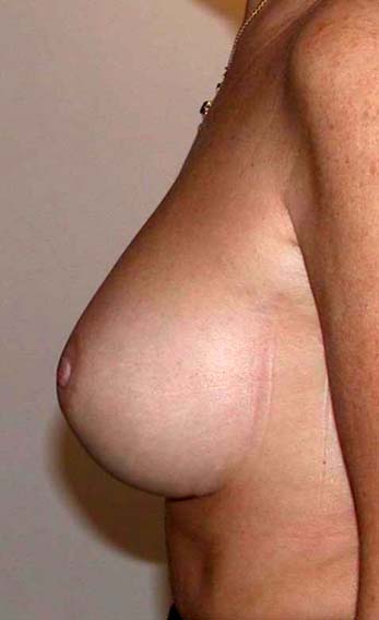 chirurgie-esthetique-secondaire-pnahon023