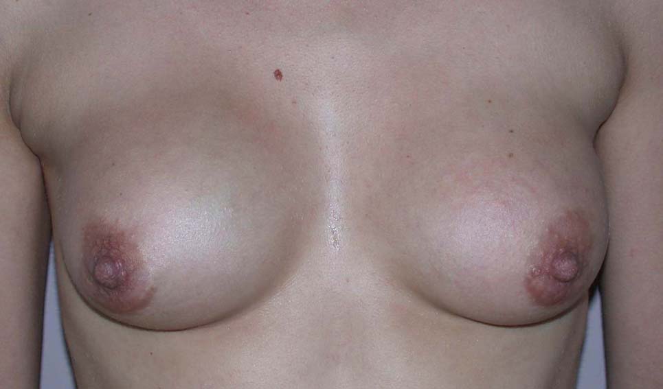 chirurgie-esthetique-secondaire-pnahon024