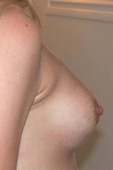 chirurgie-esthetique-secondaire-pnahon027