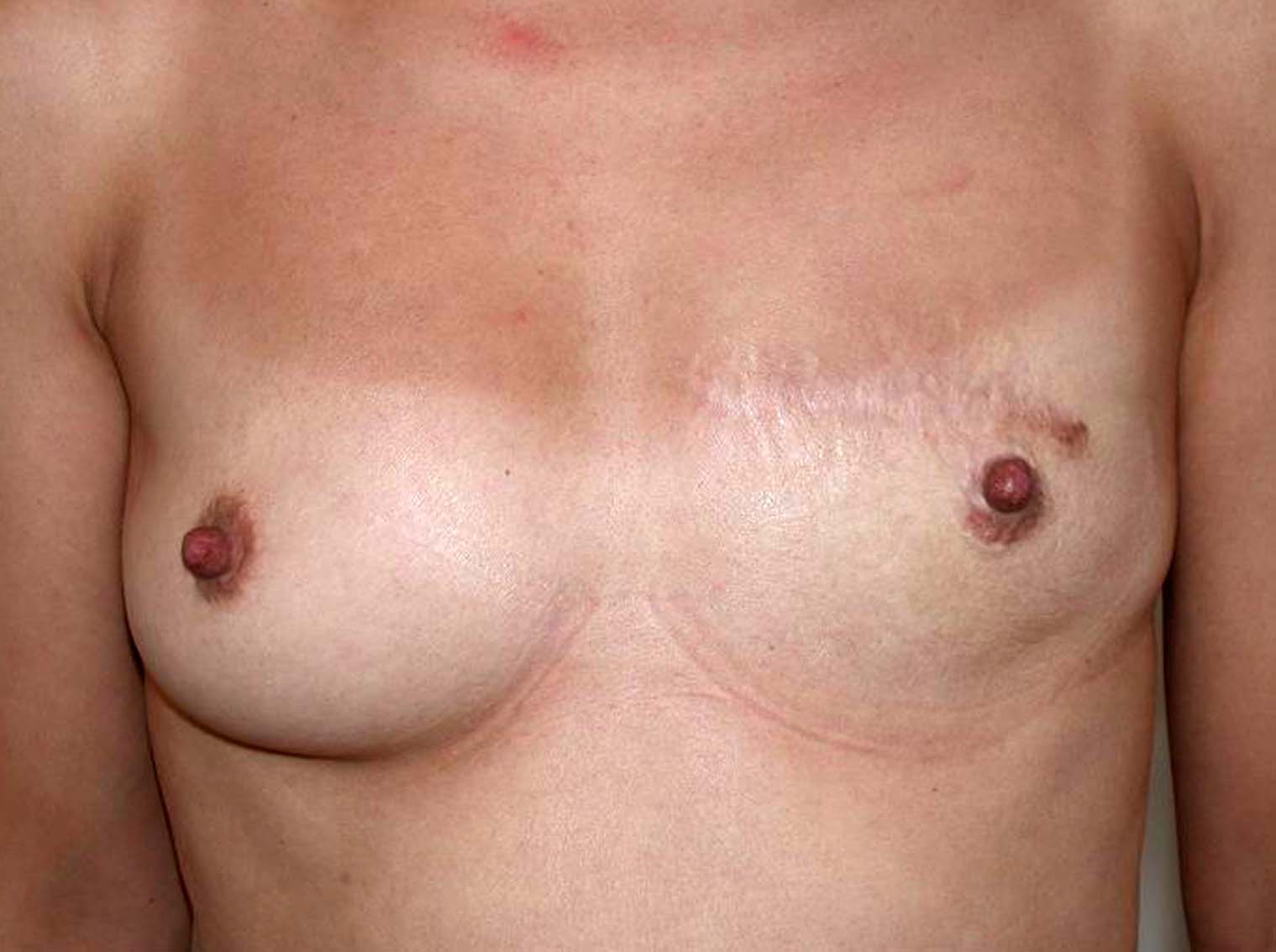 chirurgie-esthetique-secondaire-pnahon040