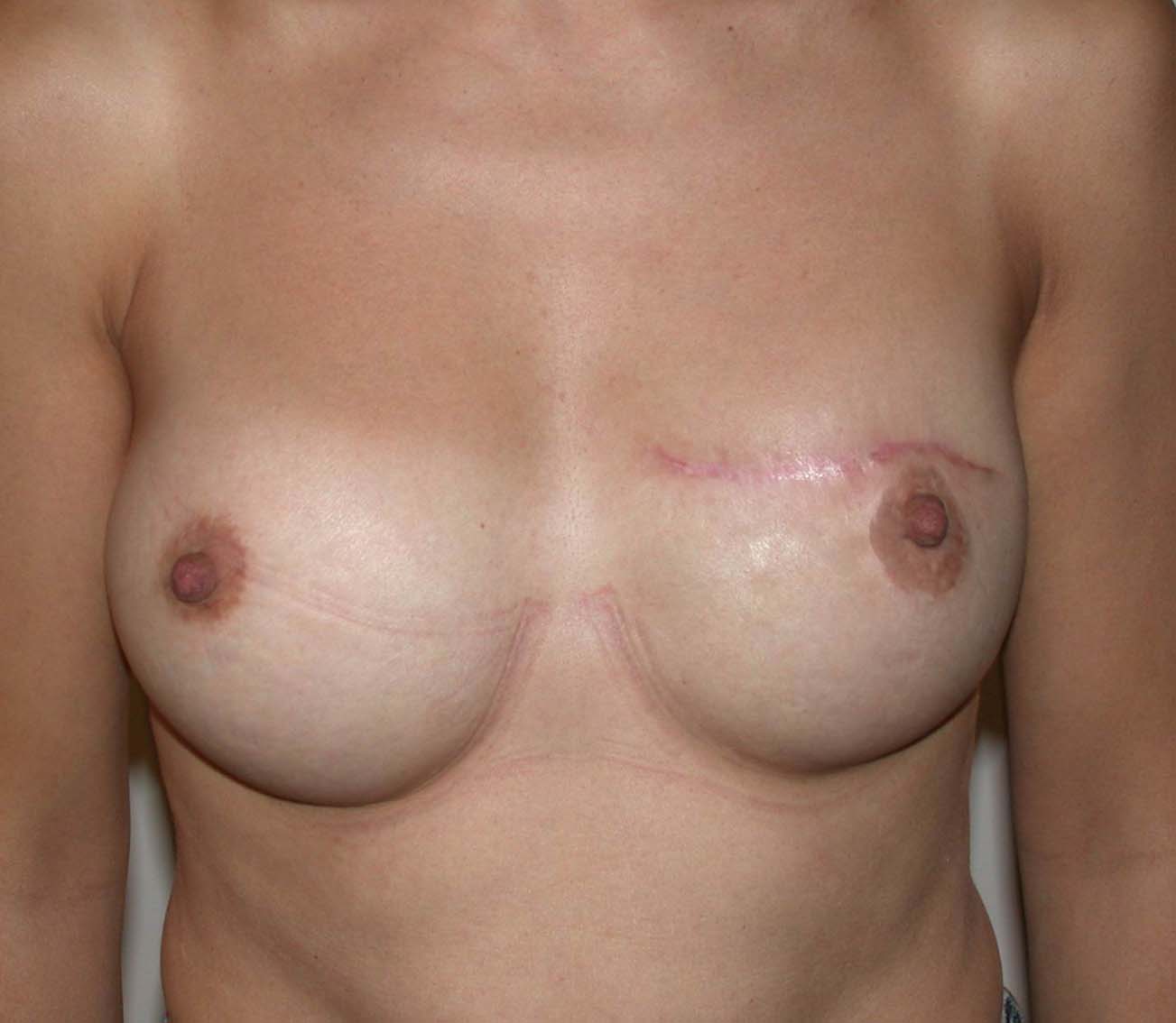 chirurgie-esthetique-secondaire-pnahon041